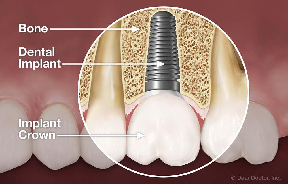 Dental Implant.