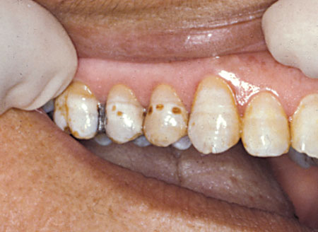 Fluorosis.