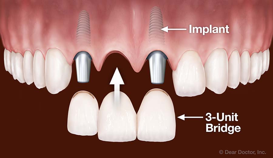 Dental Implants Replace Multiple Teeth.