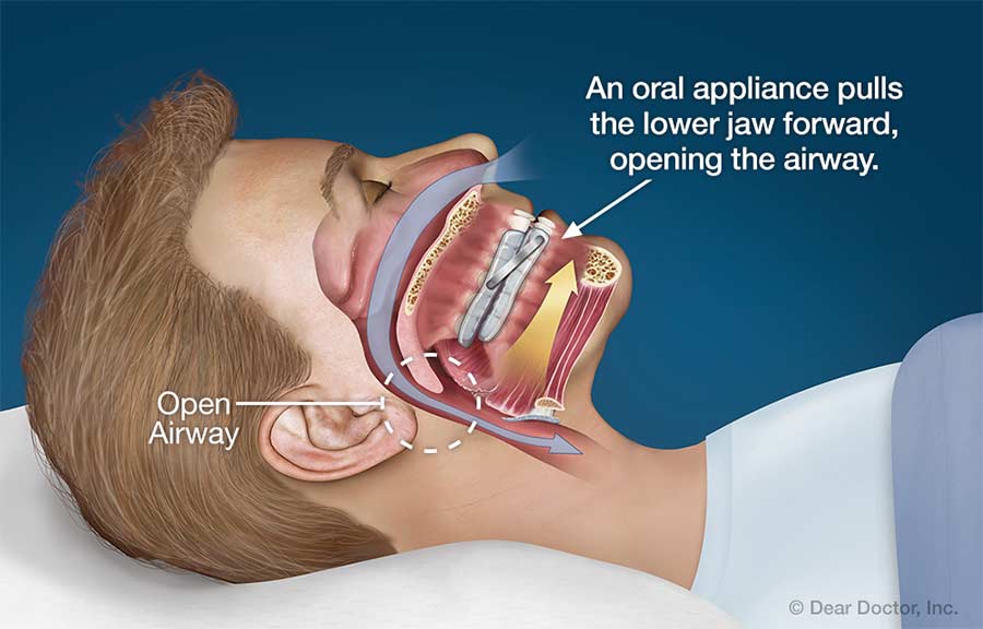 Oral Appliance Therapy.